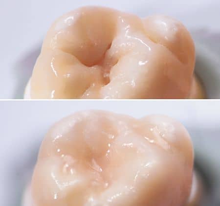 Teeth sealing