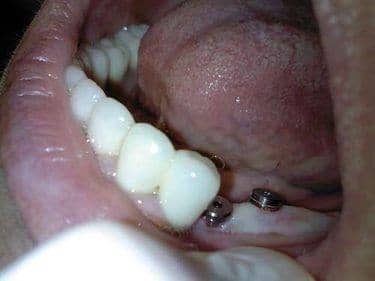 pacient dentist implant dentar