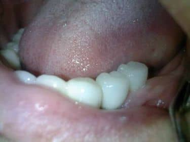 patient dental implant