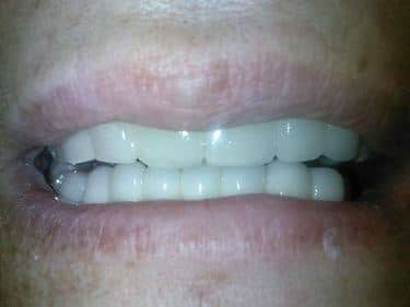 patient dental implant
