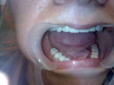 proteza dentara flexiplast