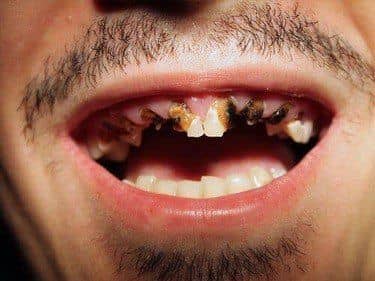 Dentinogeneza imperfecta