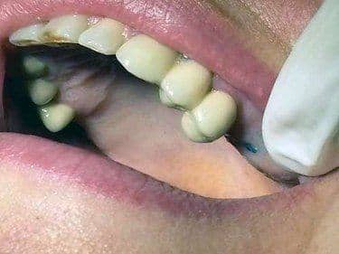 caz clinic stomatologie implant dentar
