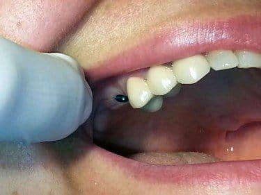 caz clinic stomatologie implant dentar