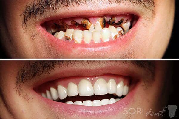 Amelogenesis imperfecta - Coroane Dentare din Zirconiu - Înainte și după tratamentul stomatologic