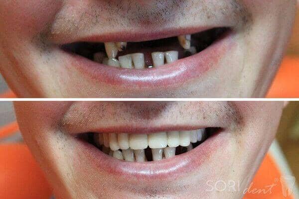 Ceramic dental bridge - Before and after dental treatment