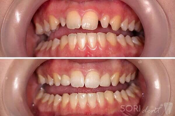 Coroane Dentare din Zirconiu - Înainte și după tratamentul stomatologic