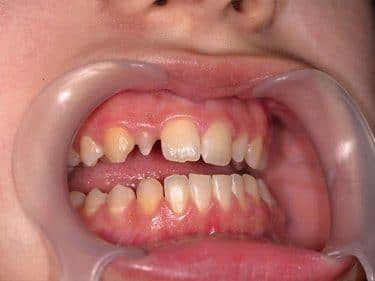disproportioned maxillary lateral incisors