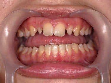 Dinți frontali nanici