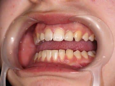 restored shape of upper lateral incisors