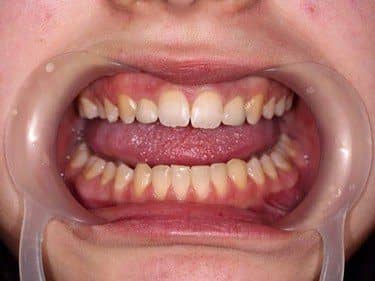 Caz clinic - dintii laterali nanici