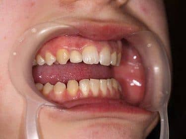corrected shape of upper lateral incisors