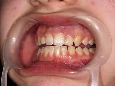 restored volume of upper lateral incisors