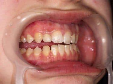 restored volume of upper lateral incisors