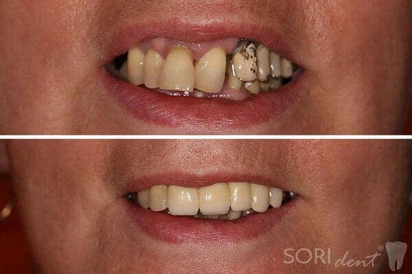 Porcelain dental bridge - Before and after dental treatment