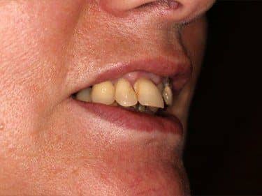 malpositioned teeth