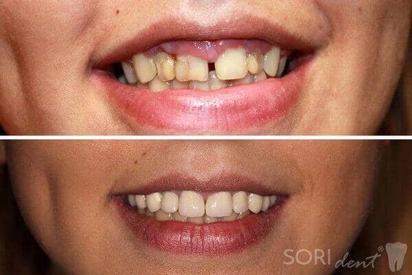 Zirconia dental crowns - Before and after dental treatment