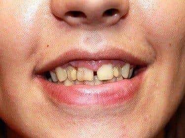 Teeth cavities