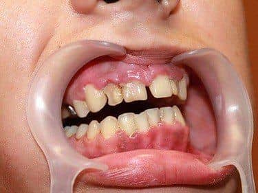 Teeth cavities