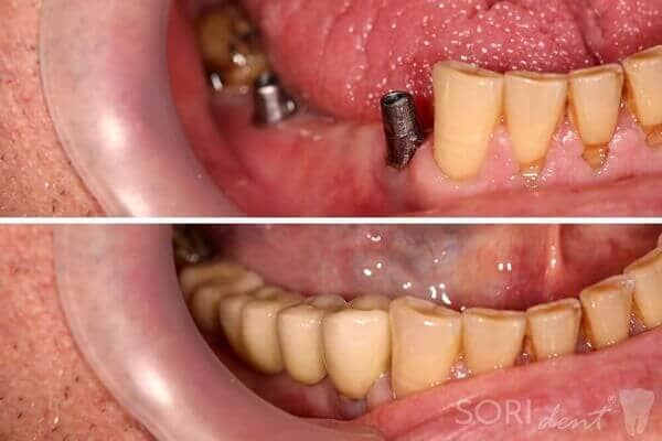 Dental implants - Before and after dental treatment
