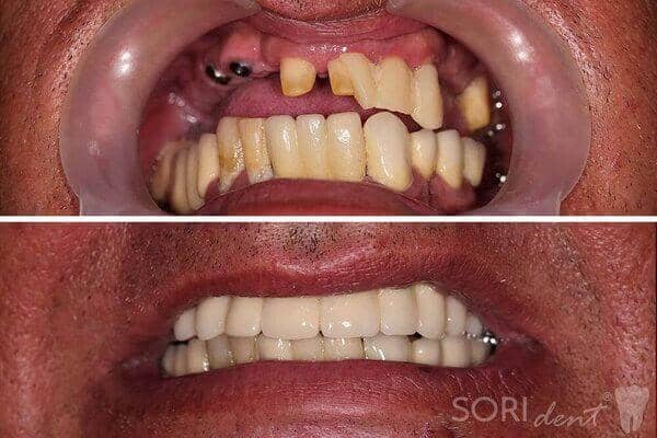 Implanturi Dentare și Punte Dentară din Ceramică - Înainte și după tratamentul stomatologic
