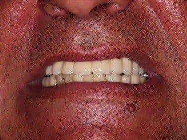 porcelain teeth