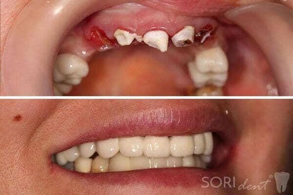 Zirconia dental crowns over implants - Before and after dental treatment