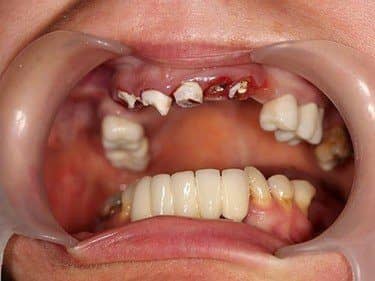 dinți fracturați