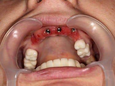 implanturi dentare inserate post-extracțional
