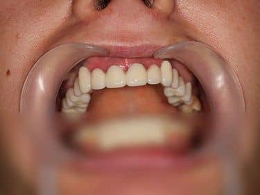 punte dentară fixă din Zirconiu