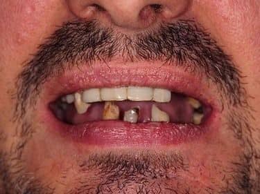 dinți mobili