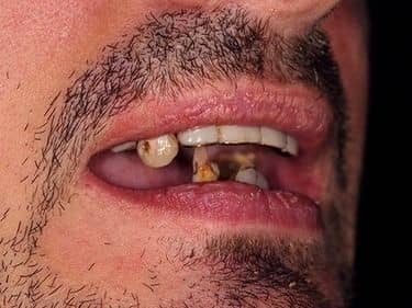 very decayed teeth