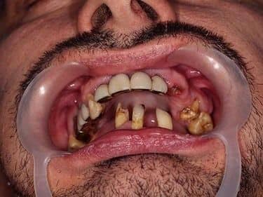 very decayed teeth