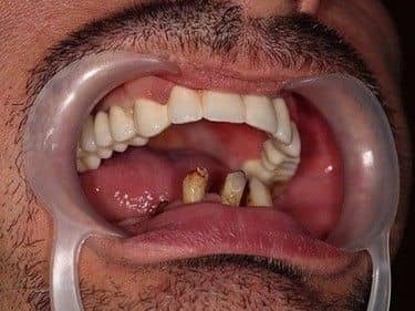 fixed upper teeth