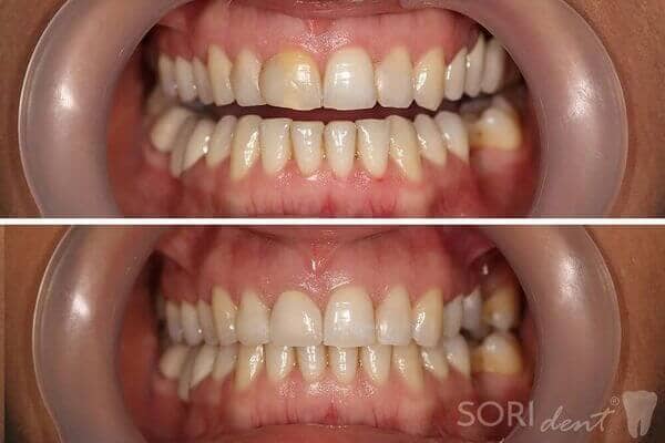 Ceramic zirconia dental crowns - Before and after dental treatment