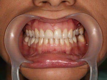 lucrare dentara zirconiu