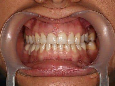 zirconia crown and composite fillings