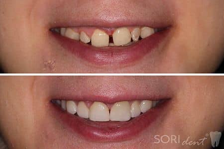 clinical case no 30 - dental veneers