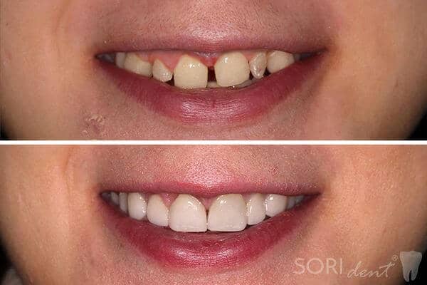 Dental veneers and e-max ceramic crowns - Before and after dental treatment
