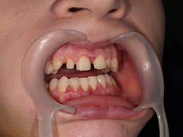Teeth prepared for veneers and crowns