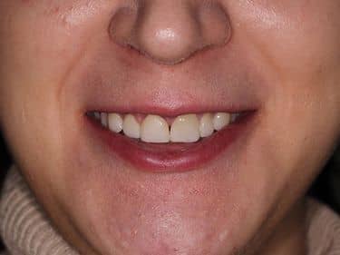 Fațete dentare și coroane integral ceramice e-max - Zâmbet frumos