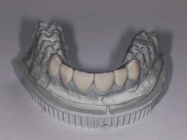 dental veneers mold