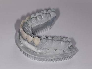 dental veneers mold