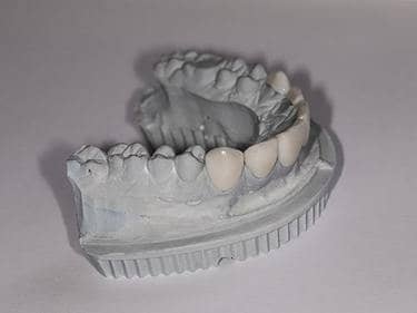 model fațete dentare