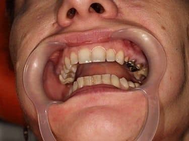 prepared teeth