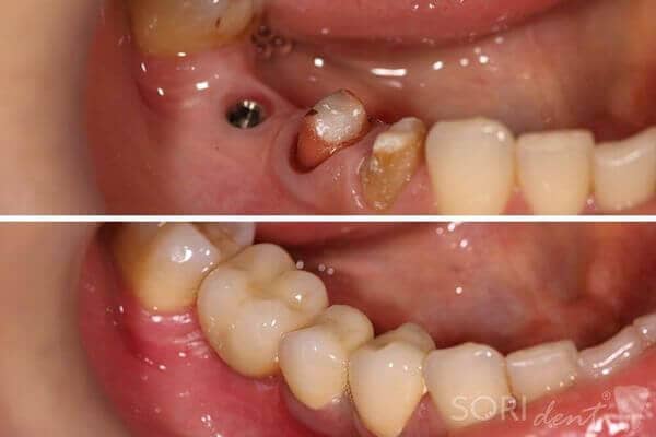 Implant Dentar și Coroane Dentare din Zirconiu - Înainte și după tratamentul stomatologic
