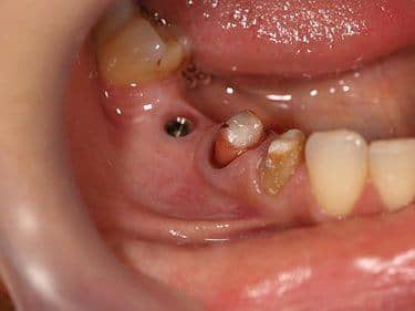 Implant dentar și dinți pregătiți pentru a fi îmbrăcați cu coroane