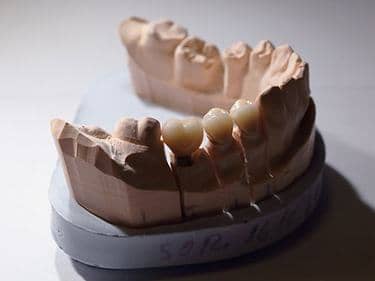 Coroane Dentare din Zirconiu