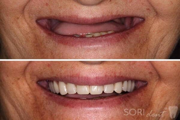 Dentures - Before and after dental treatment