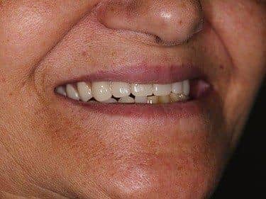 Complete and partial Dentures
